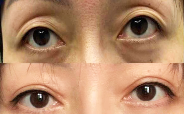 年輕人眼窩凹陷是什么原因?年輕人眼窩凹陷怎樣恢復(fù)?