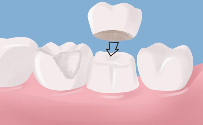 牙冠修復(fù)后能堅持幾年？