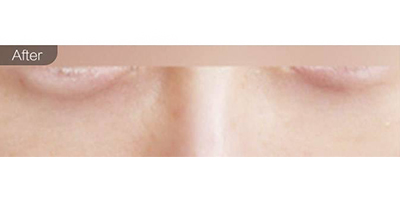 微針去黑眼圈術后