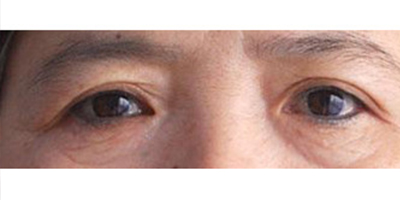 切眉術(shù)術(shù)前