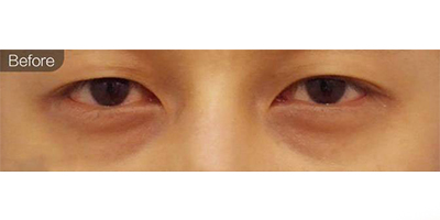 膠原蛋白去黑眼圈術前