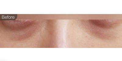 微針去黑眼圈術前