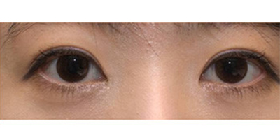開內(nèi)眼角術(shù)后