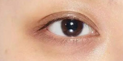 射頻去黑眼圈術(shù)前