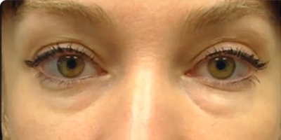 熊貓針去黑眼圈術(shù)前