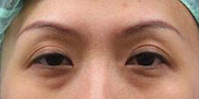 玻尿酸去黑眼圈術(shù)前