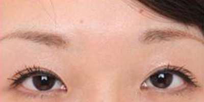 假體墊眉弓術(shù)后