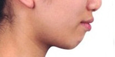自體脂肪墊下巴術(shù)前