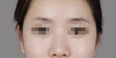 顴骨內(nèi)推術(shù)后