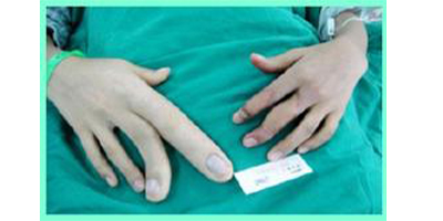 手指巨指矯正術(shù)前