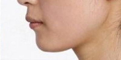 玻尿酸墊下巴術后