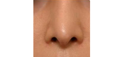 鼻部膨體假體取出術(shù)后