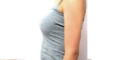 水動(dòng)力吸脂術(shù)后