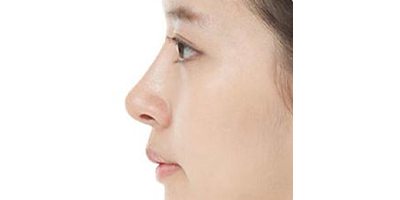 假體墊鼻基底術后