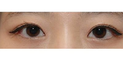 眼部多項(xiàng)術(shù)后