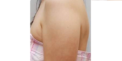 隔空溶脂瘦手臂術前