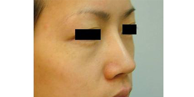 自體脂肪隆鼻術(shù)后