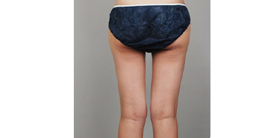 動氧瘦臀部術(shù)后