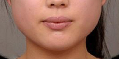 溶脂瘦臉術(shù)前