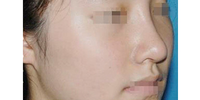 玻尿酸豐鼻基底術(shù)后