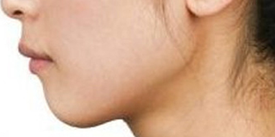 玻尿酸墊下巴術前