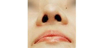 鼻部硅膠假體取出術(shù)后