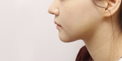 激光溶脂瘦臉術后