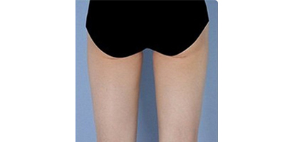 臀部吸脂術(shù)后