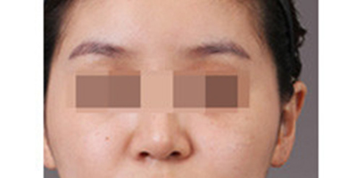 自體脂肪豐眉弓術(shù)前