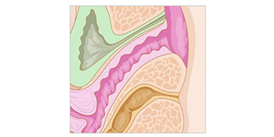 激光緊縮陰道術(shù)后