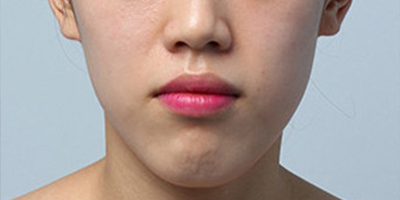 假體豐下巴術前
