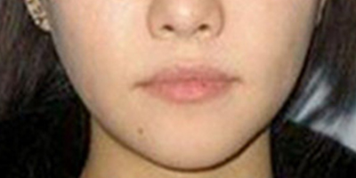 玻尿酸豐面頰術(shù)后