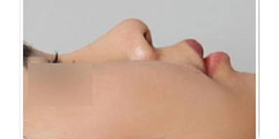 玻尿酸隆鼻術(shù)后