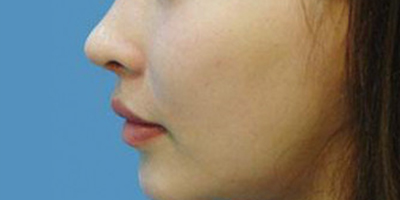 上下顎手術(shù)/突嘴矯正術(shù)后