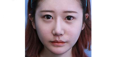 耳軟骨隆鼻術(shù)后