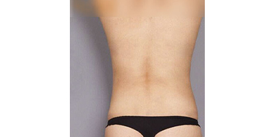 優(yōu)立塑術后