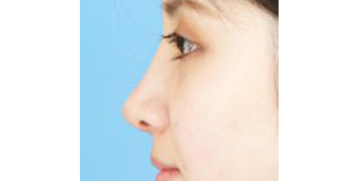 鼻部多項(xiàng)術(shù)后