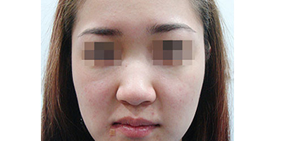 寬鼻矯正術(shù)前
