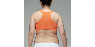 冷凍溶脂瘦背部術(shù)前