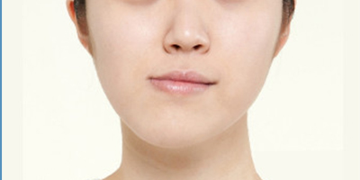面部不對稱矯正術(shù)前