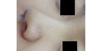 手術延長鼻小柱術前