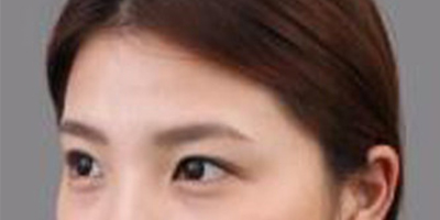 玻尿酸豐額頭術(shù)前