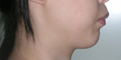 上顎前突/天包地術前