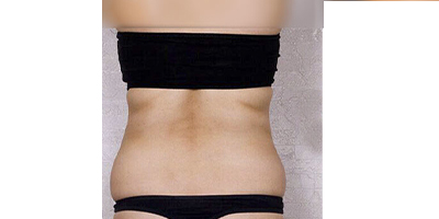 動氧瘦背部術(shù)前