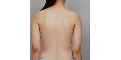 隔空溶脂瘦腰部術(shù)前