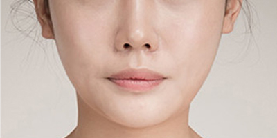 假體豐下巴術后