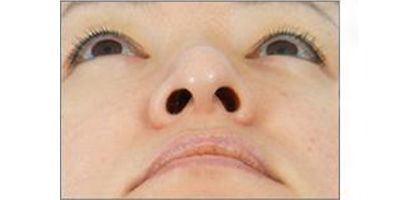 手術(shù)縮鼻頭術(shù)前