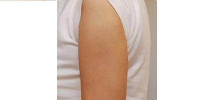 隔空溶脂瘦手臂術后