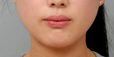 溶脂瘦臉術(shù)后