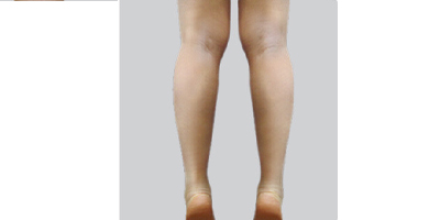 小腿神經(jīng)阻斷術(shù)術(shù)后